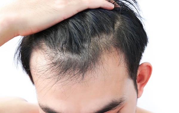 Close Up Of Man With Receding Hairline Against White Background